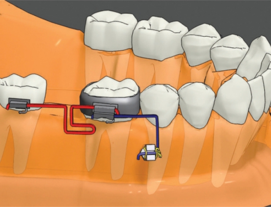 Bracket Head (Left handed screw)