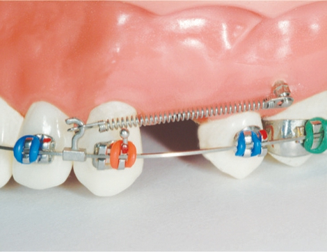 Dentos Korea Variable Crimpable Hooks