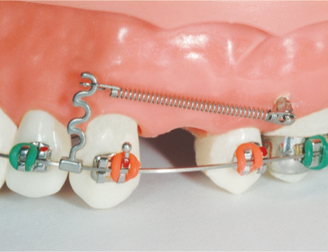 Dentos Korea Variable Crimpable Hooks