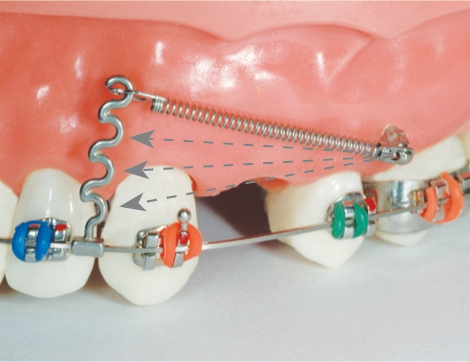 Dentos Korea Variable Crimpable Hooks